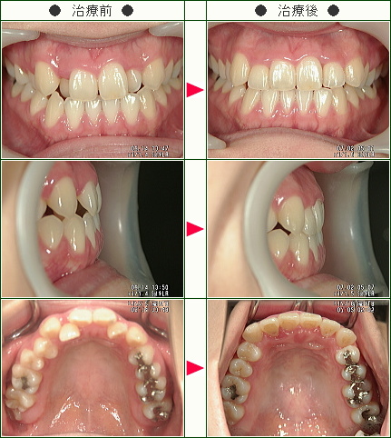 歯のデコボコ矯正症例(矢口様　２９歳　女性)