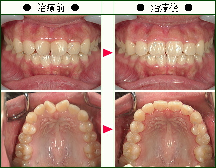 歯のデコボコ矯正症例(やはた様　１９歳　女性)