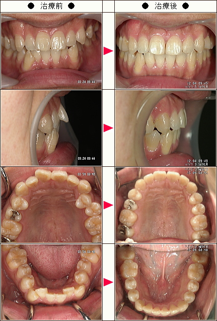 歯のデコボコ矯正症例［山田様　３０歳　男性］