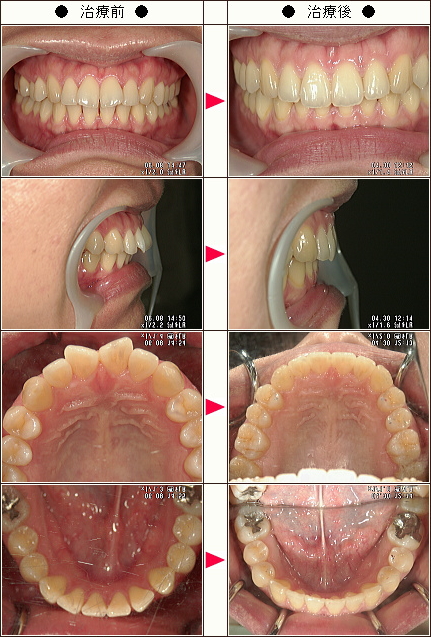 出っ歯矯正症例［山田様　３２歳　女性］