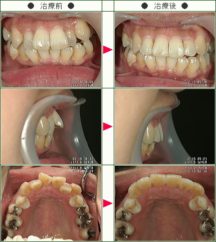 歯のデコボコ症例(山田様　４６歳　女性)