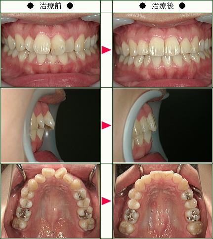 歯のデコボコ矯正症例(山口様　２３歳　女性)