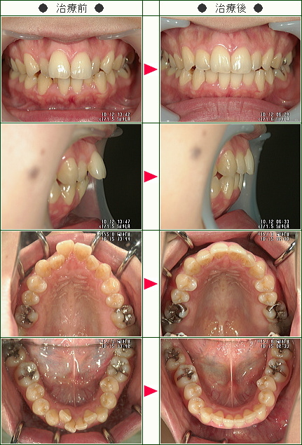歯のデコボコ矯正症例(山本様　３２歳　男性)