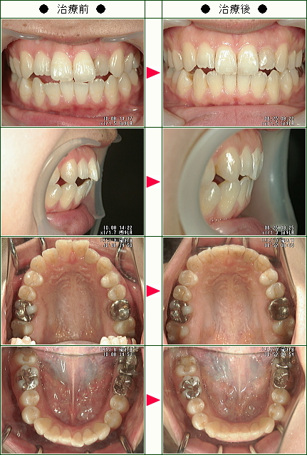 歯のデコボコ矯正症例(ヤマザキ様　２２歳　女性 )