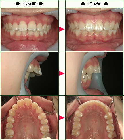 出っ歯矯正症例(山崎様　２２歳　女性)