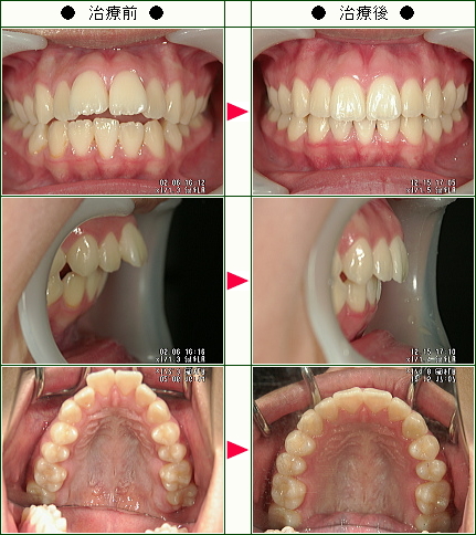 出っ歯矯正症例(柳下様　１４歳　女性)