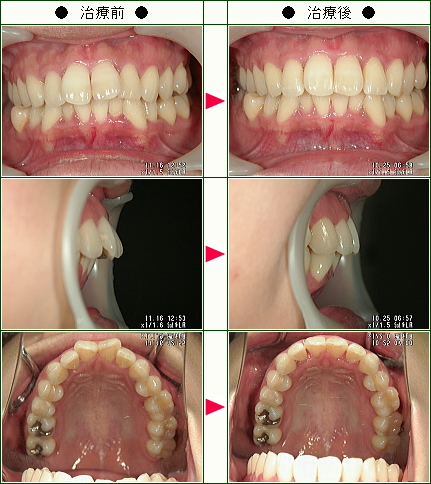 歯のデコボコ矯正症例(ｙａｙｏｉ様　３０歳　女性)