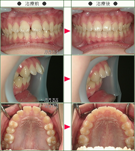 出っ歯矯正症例(Ｙ・Ｅ様　１３歳　女性)