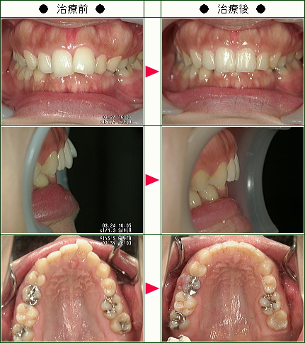 出っ歯矯正症例(Ｙ.Ｆ様　２６歳　女性)