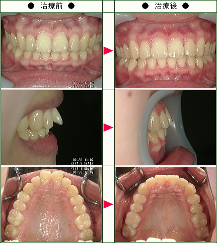 歯のデコボコ矯正症例(Ｙ.Ｇ様　２１歳　女性)