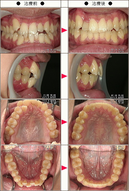 歯のデコボコ矯正症例［Ｙ．Ｈ様　２１歳　男性］