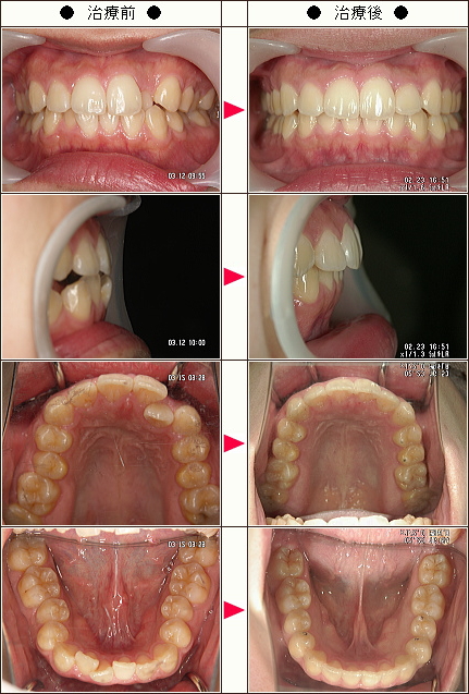 歯のデコボコ矯正症例［Ｙ・Ｈ様　２３歳　女性］