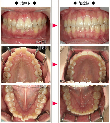 歯のデコボコ矯正症例［Ｙ.Ｈ様　２５歳　女性］