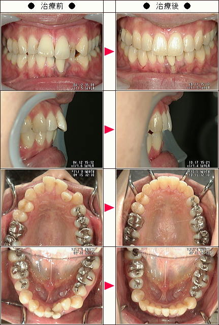 歯のデコボコ矯正症例［Ｙ・Ｈ様　３１歳　女性］