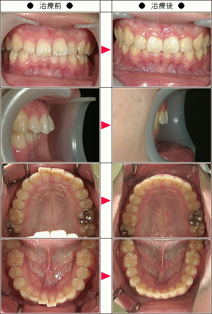 歯のデコボコ矯正症例［Ｙ．Ｈ様　３１歳　男性］