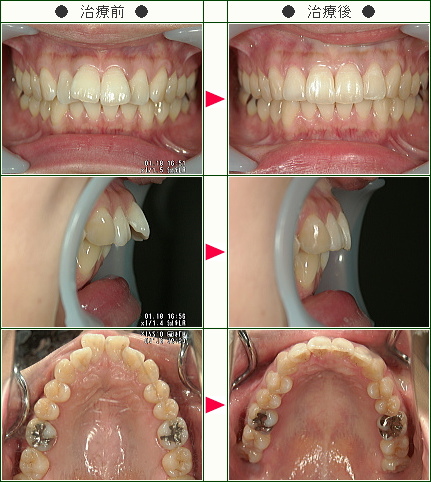 出っ歯矯正症例(Ｙ・Ｉ様　２９歳　女性)