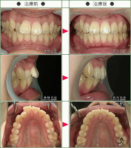 出っ歯矯正症例(Ｙ・Ｉ様　３０歳　女性)