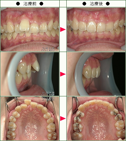歯のデコボコ矯正症例(Ｙ.Ｉ様　３０歳　男性)