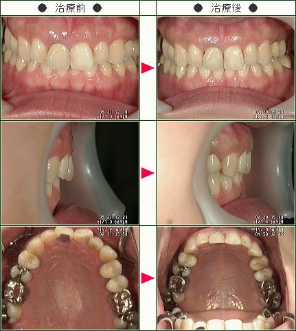 歯のデコボコ矯正症例(Ｙ．Ｉ．様　３４歳　女性)