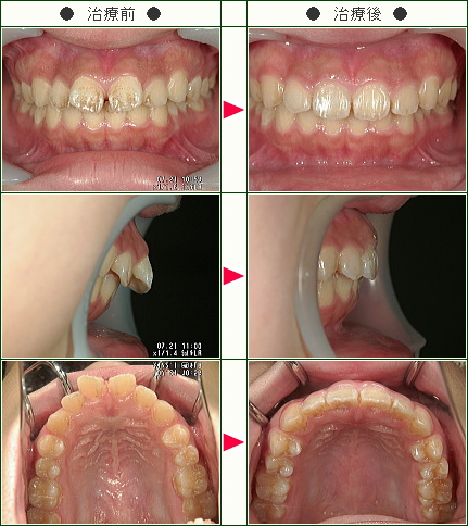 出っ歯矯正症例(Ｙ・Ｋ様　１６歳　女性)