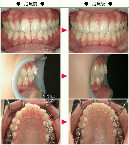 歯のデコボコ矯正症例(Ｙ.Ｋ様　２３歳　女性)