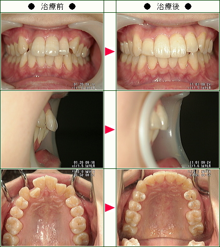 歯のデコボコ矯正症例(Ｙ・Ｋ様　２５歳　女性)