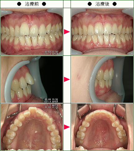 出っ歯矯正症例(Ｙ．Ｋ様　２６歳　女性)