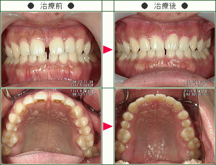 前歯のすきっ歯矯正症例(Ｙ．Ｋ様　２８歳　男性)