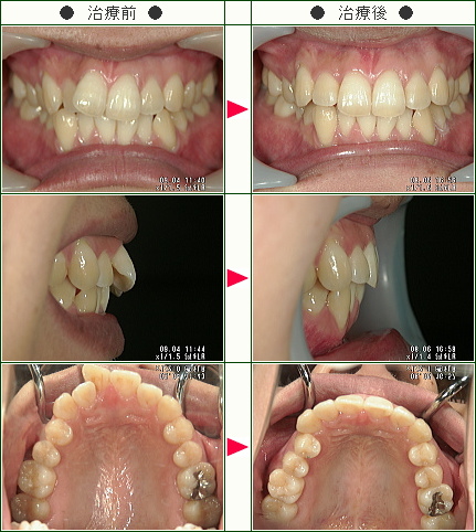 歯のデコボコ矯正症例(ＹＫ様　３０歳　女性)