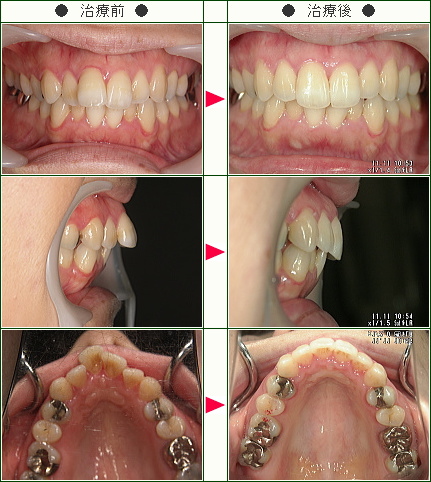 出っ歯矯正症例(Ｙ・Ｋ様　３１歳　女性)