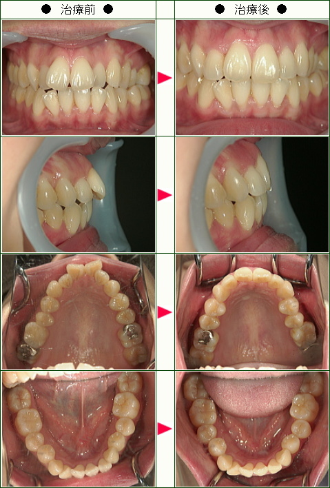 歯のデコボコ矯正症例(Ｙ．Ｋ様　３４歳　女性)