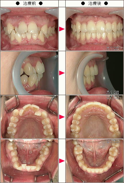 歯のデコボコ矯正症例［Ｙ．Ｋ様　３５歳　女性］