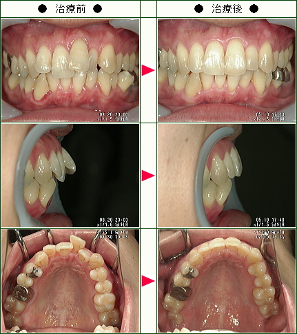 歯のデコボコ矯正症例(Ｙ．Ｋ様　３５歳　男性)