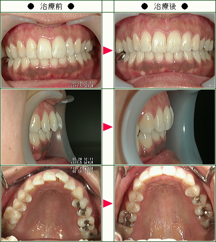 歯のデコボコ矯正症例(Ｙ.Ｋ様　３６歳　女性)