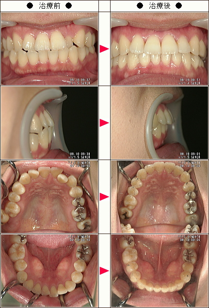出っ歯矯正症例［Ｙ子様　３０歳　女性］