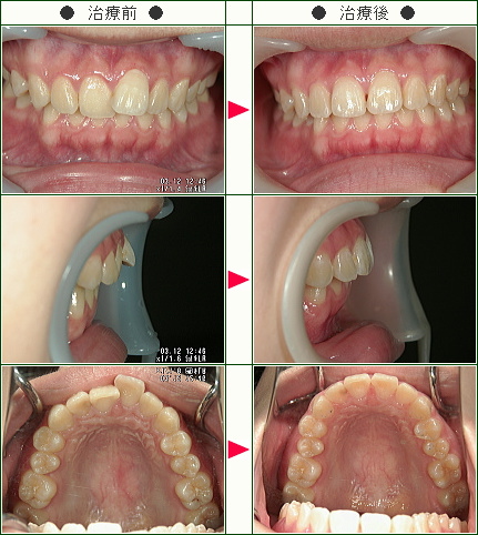 歯のデコボコ症例(Ｙ.Ｍ様　１８歳　女性)