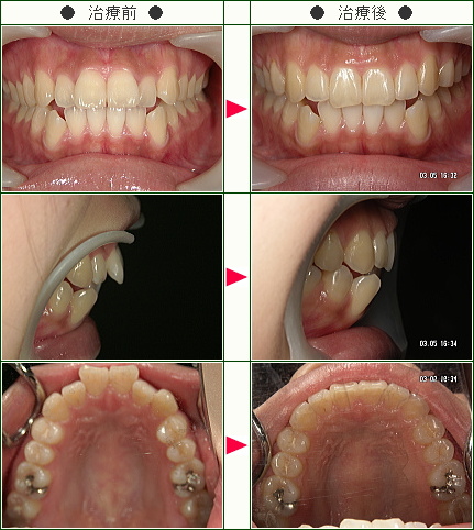歯のデコボコ矯正症例(Ｙ．Ｍ．様　２０歳　女性)