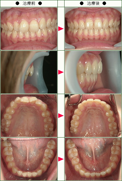 歯のデコボコ矯正症例(Ｙ．Ｍ様　２３歳　女性)