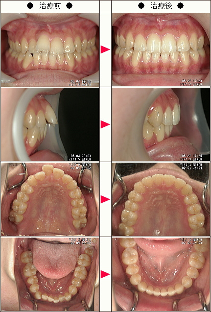 歯のデコボコ矯正症例［Ｙ・Ｍ様　２４歳　女性］