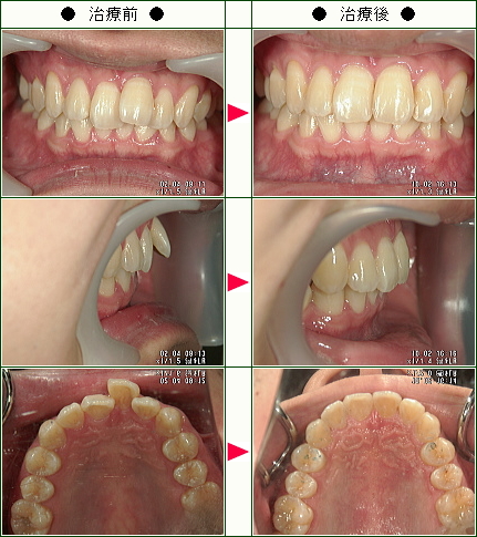歯のデコボコ矯正症例(Ｙ・Ｍ様　２４歳　男性)