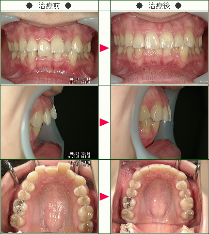 歯のデコボコ矯正症例(Ｙ.Ｍ様　２７歳　女性)