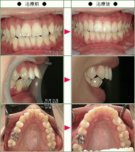 出っ歯矯正症例(Ｙ・Ｍ様　２７歳　女性)