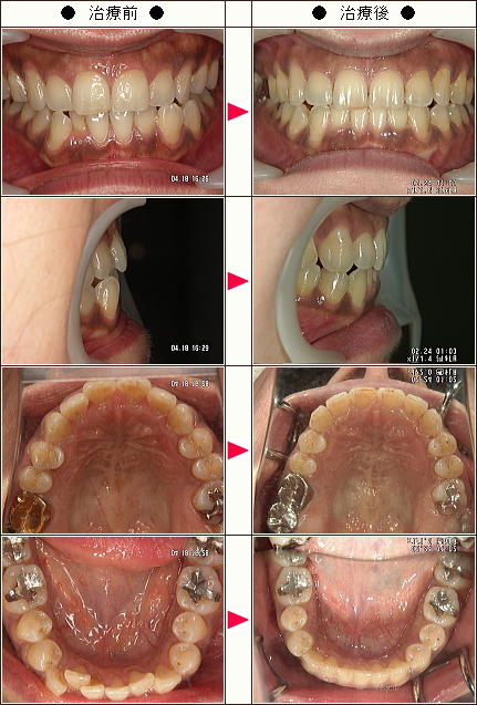 歯のデコボコ矯正症例［Ｙ・Ｍ様　３０代　女性］