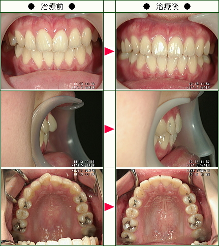 歯のデコボコ矯正症例(Ｙ.Ｎ様　２５歳　女性)