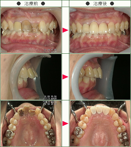 出っ歯矯正症例(Ｙ・Ｎ様　４７歳　女性)