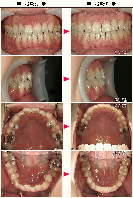 歯のデコボコ矯正症例［Ｙ．Ｎ様　女性］