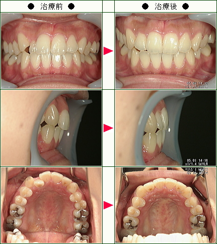 歯のデコボコ矯正症例(Ｙ.Ｏ様　２８歳　女性)