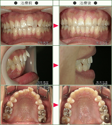 歯のデコボコ矯正症例(Ｙ・Ｏ様　２９歳　女性)
