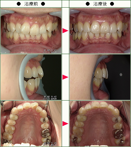 歯のデコボコ矯正症例(Ｙ.Ｏ様　女性)