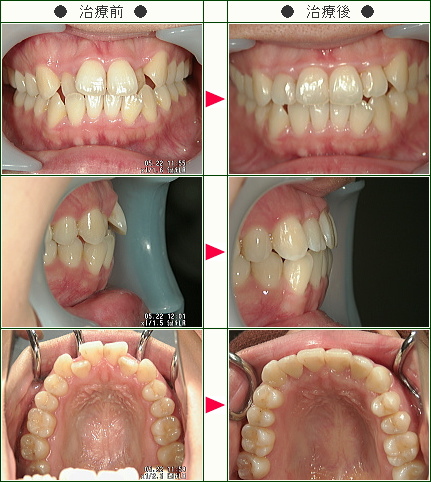 歯のデコボコ矯正症例(吉田様　２８歳　女性)